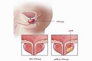 نشانگرهای زیستی تشخیصی در سرطان پروستات