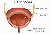 یک هدف جدید و بالقوه در سرطان مثانه
