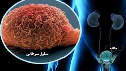 ایمونوتراپی ترکیبی و تقلیدی Smac برای درمان سرطان سلولهای یوروتلیال