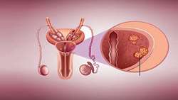  تحلیل جامع ژن‌های مرتبط با mg7، METTL1 و WDR4 ، برای پیش‌بینی پیش‌آگهی و عملکردهای انکوژنیک در سرطان پروستات