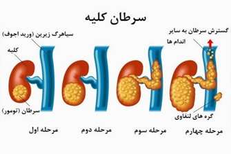 بیان همزمان ژن های چندگانه PAX در کارسینوم سلول کلیوی (RCC) و ارتباط بیان PAX بالا با پیامد بالینی مطلوب در بیماران RCC