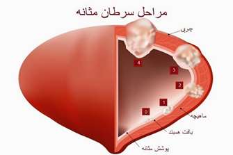 توسعه یک مدل سرطان مثانه روی یک تراشه برای ارزیابی تهاجم سلول های سرطانی مثانه